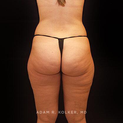 Liposuction Before Image Patient 04 Side View