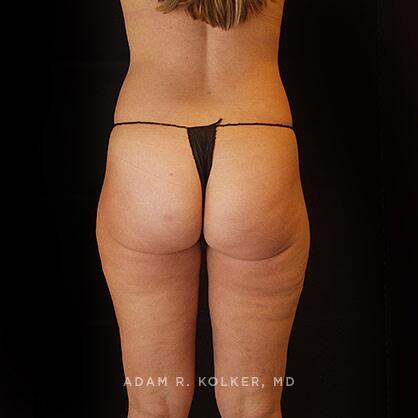 Liposuction After Image Patient 04 Side View