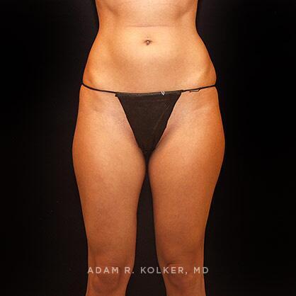 Liposuction Before Image Patient 06 Front View