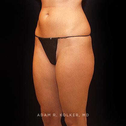 Liposuction Before Image Patient 06 Oblique View