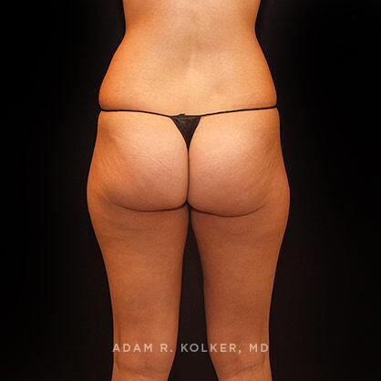 Liposuction Before Image Patient 06 Side View
