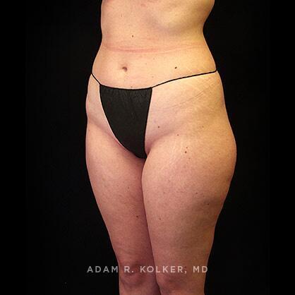 Liposuction Before Image Patient 08 Oblique View