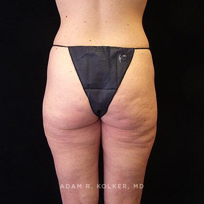 Liposuction After Image Patient 08 Side View