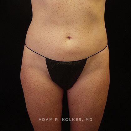 Liposuction After Image Patient 09 Front View