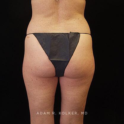 Liposuction Before Image Patient 09 Side View