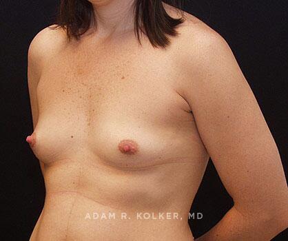 Mommy Makeover Before Image Patient 04 Oblique View
