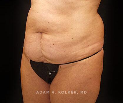 Mommy Makeover Before Image Patient 11 Oblique View