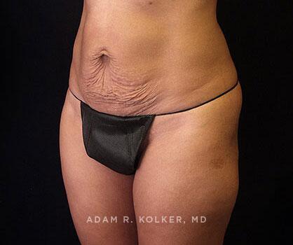 Mommy Makeover Before Image Patient 12 Oblique View