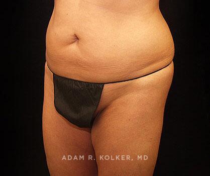 Mommy Makeover Before Image Patient 13 Oblique View