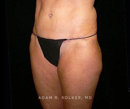 Mommy Makeover After Image Patient 14 Oblique View