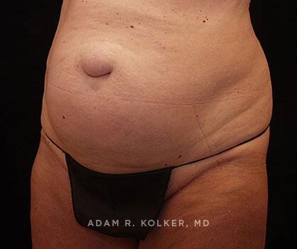 Mommy Makeover Before Image Patient 15 Oblique View