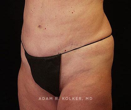 Mommy Makeover After Image Patient 15 Oblique View