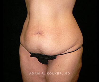 Mommy Makeover Before Image Patient 17 Oblique View