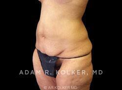 Surgery After Weight Loss Before Image Patient 06 Oblique View