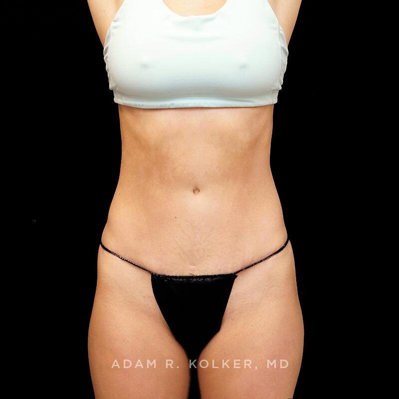 Tummy Tuck After Image Patient 01 Front View