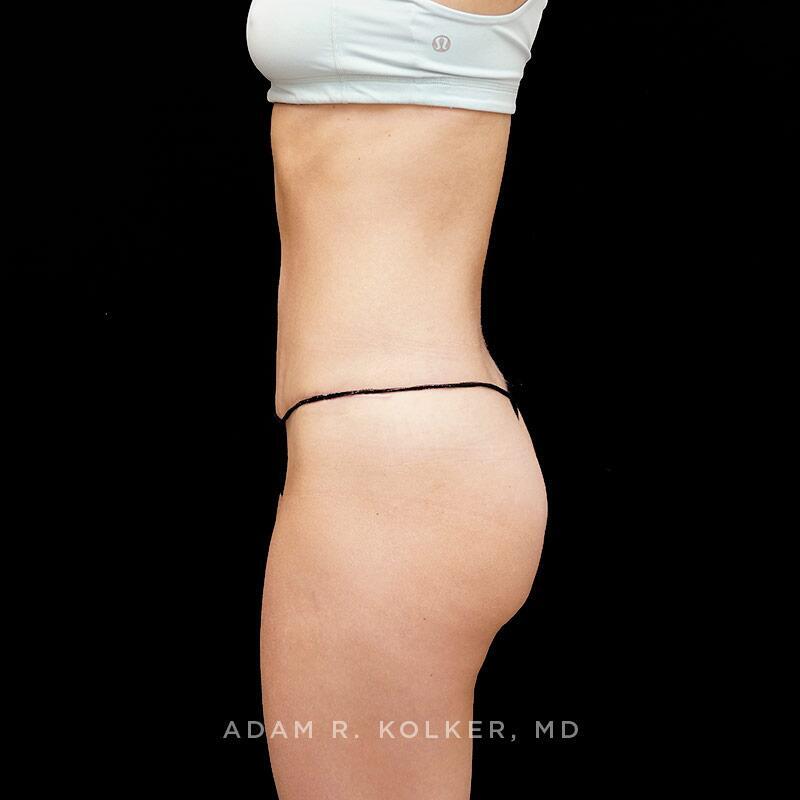 Tummy Tuck After Image Patient 01 Side View