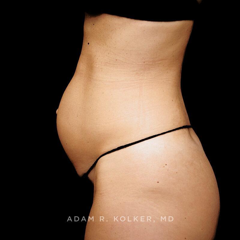 Tummy Tuck Before Image Patient 02 Side View