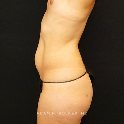 Tummy Tuck Before Image Patient 03 Side View