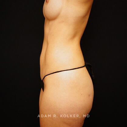 Tummy Tuck After Image Patient 03 Side View