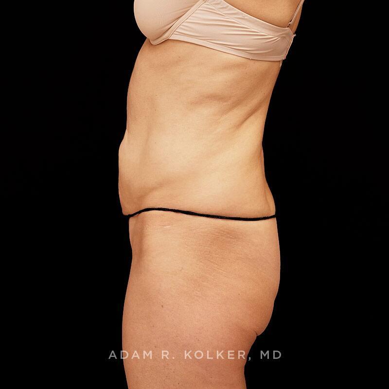 Tummy Tuck Before Image Patient 06 Side View