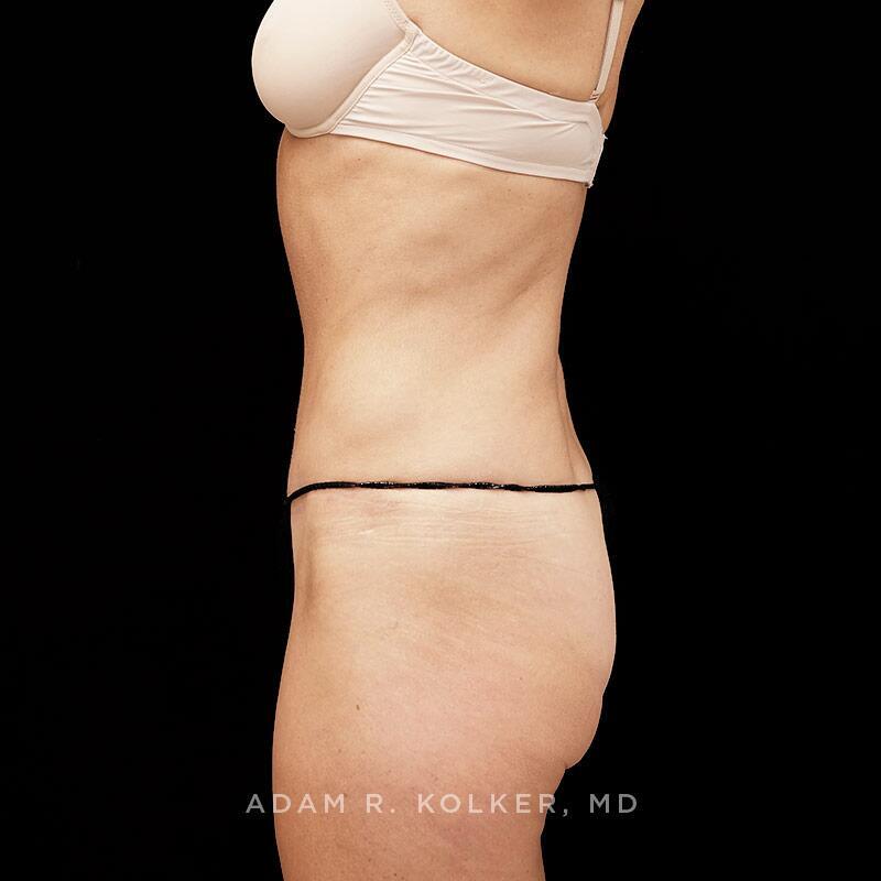 Tummy Tuck After Image Patient 06 Side View