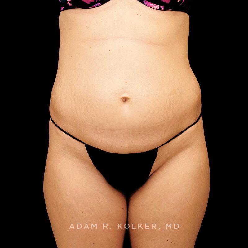 Tummy Tuck Before Image Patient 07 Front View