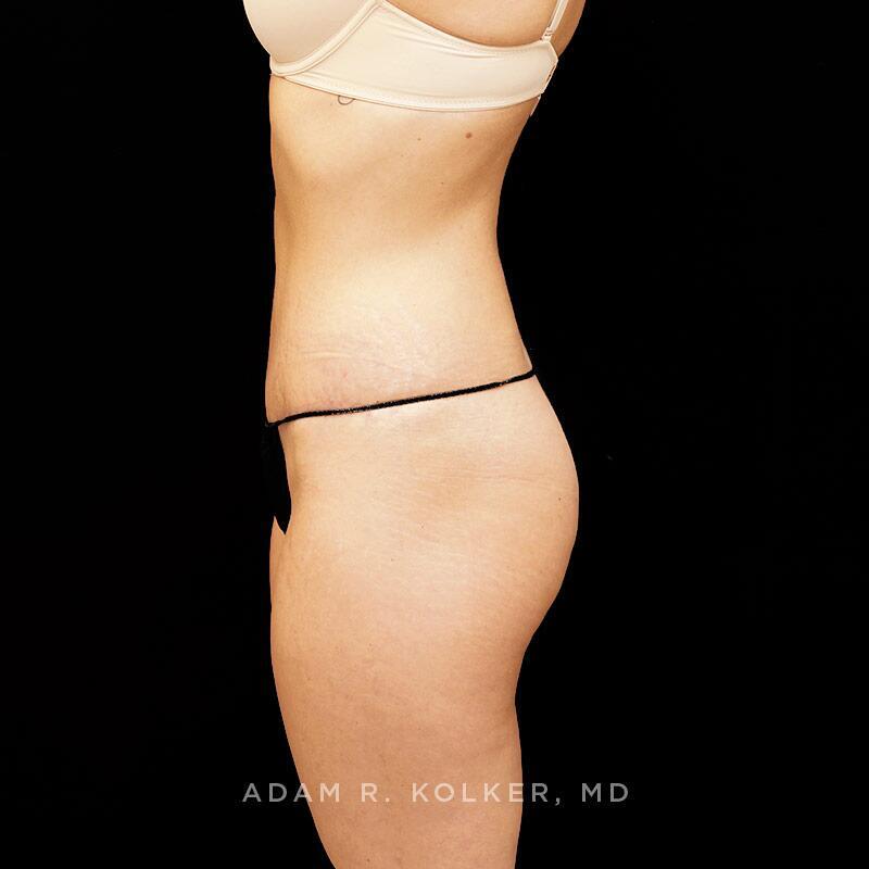 Tummy Tuck After Image Patient 07 Side View