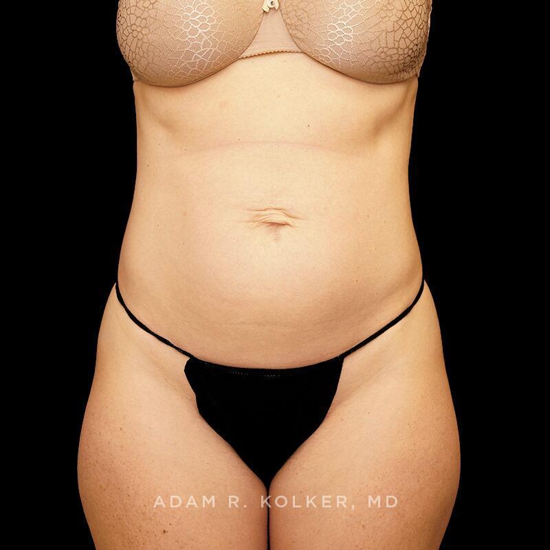 Tummy Tuck Before Image Patient 10 Front View