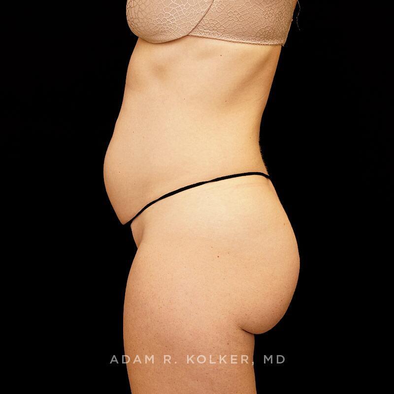 Tummy Tuck Before Image Patient 10 Side View