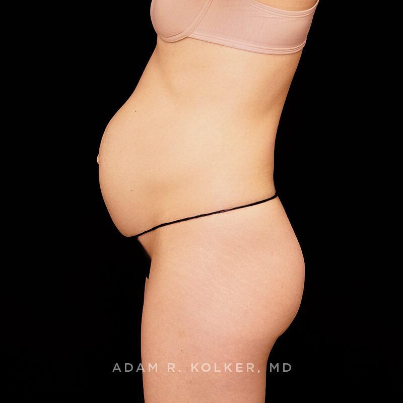 Tummy Tuck Before Image Patient 16 Side View