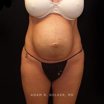 Tummy Tuck Before Image Patient 17 Front View