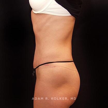 Tummy Tuck After Image Patient 17 Side View