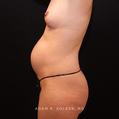 Tummy Tuck Before Image Patient 18 Side View