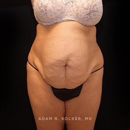 Tummy Tuck Before Image Patient 20 Front View
