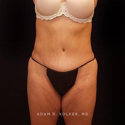 Tummy Tuck After Image Patient 20 Front View