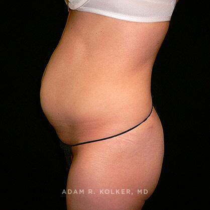 Tummy Tuck Before Image Patient 22 Side View