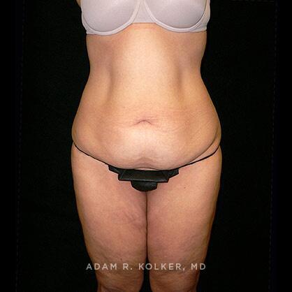 Tummy Tuck Before Image Patient 24 Front View