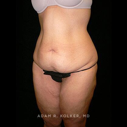 Tummy Tuck Before Image Patient 24 Oblique View