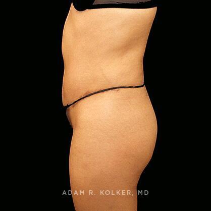 Tummy Tuck After Image Patient 26 Side View