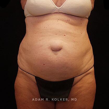 Tummy Tuck Before Image Patient 27 Front View