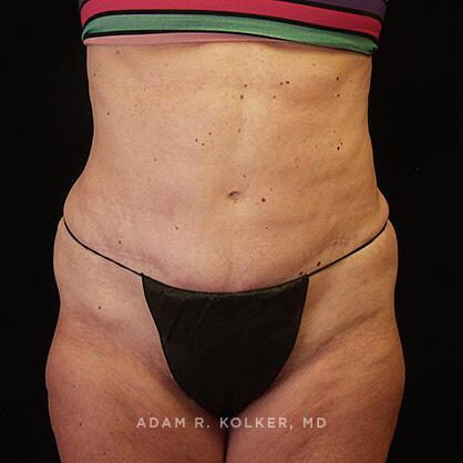 Tummy Tuck After Image Patient 27 Front View
