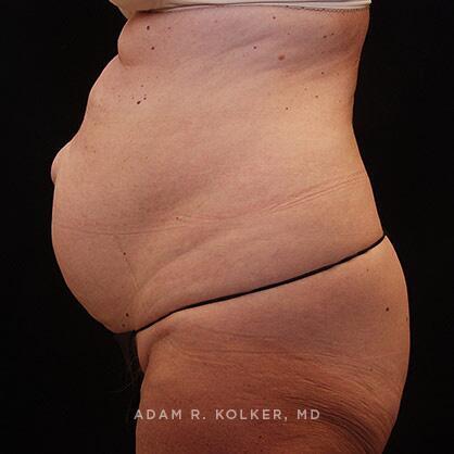 Tummy Tuck Before Image Patient 27 Side View