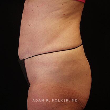 Tummy Tuck After Image Patient 27 Side View
