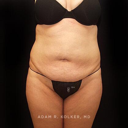 Tummy Tuck Before Image Patient 28 Front View