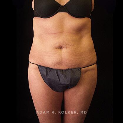Tummy Tuck Before Image Patient 32 Front View