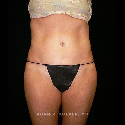 Tummy Tuck After Image Patient 32 Front View
