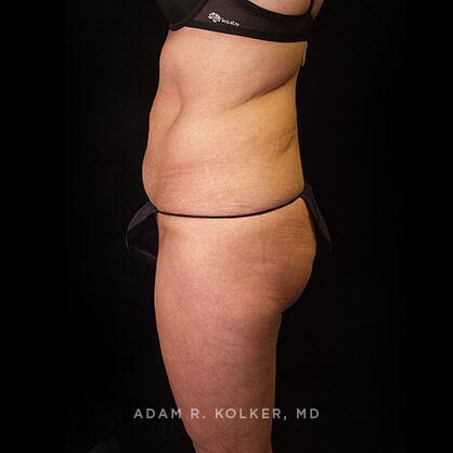 Tummy Tuck Before Image Patient 32 Side View