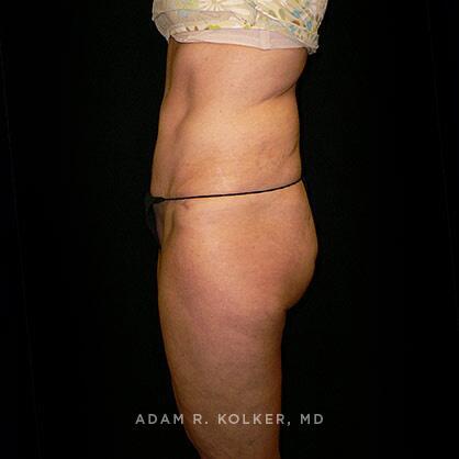 Tummy Tuck After Image Patient 32 Side View