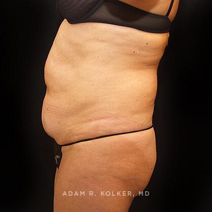 Tummy Tuck Before Image Patient 33 Side View