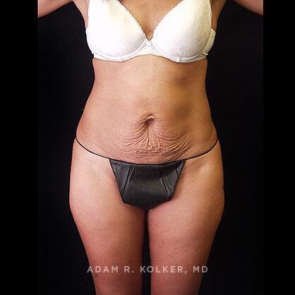Tummy Tuck Before Image Patient 34 Front View